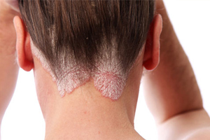 симптомы вульгарного псориаза